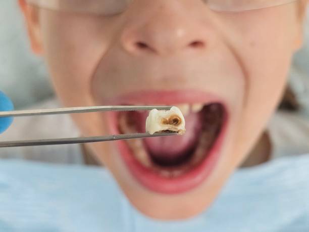 Best Emergency Treatment for Dental Infections or Abscesses in Su Oswego, NY